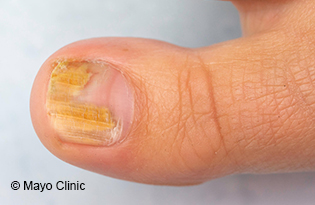 Onychomycosis