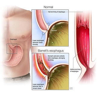 Barrett's esophagus Barrett's esophagus medical illustration