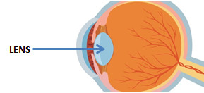 CataractEyeLens