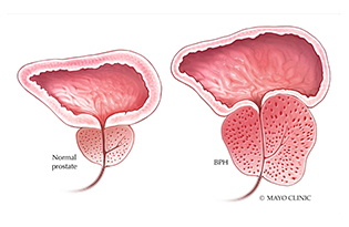 BPH
