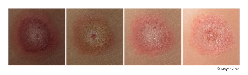 LymeDiseaseRash1