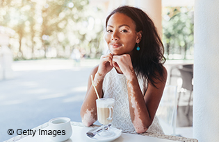 Vitiligo: What to know about white patches on the skin