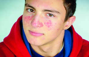 ECH_TeenAcne_widget
